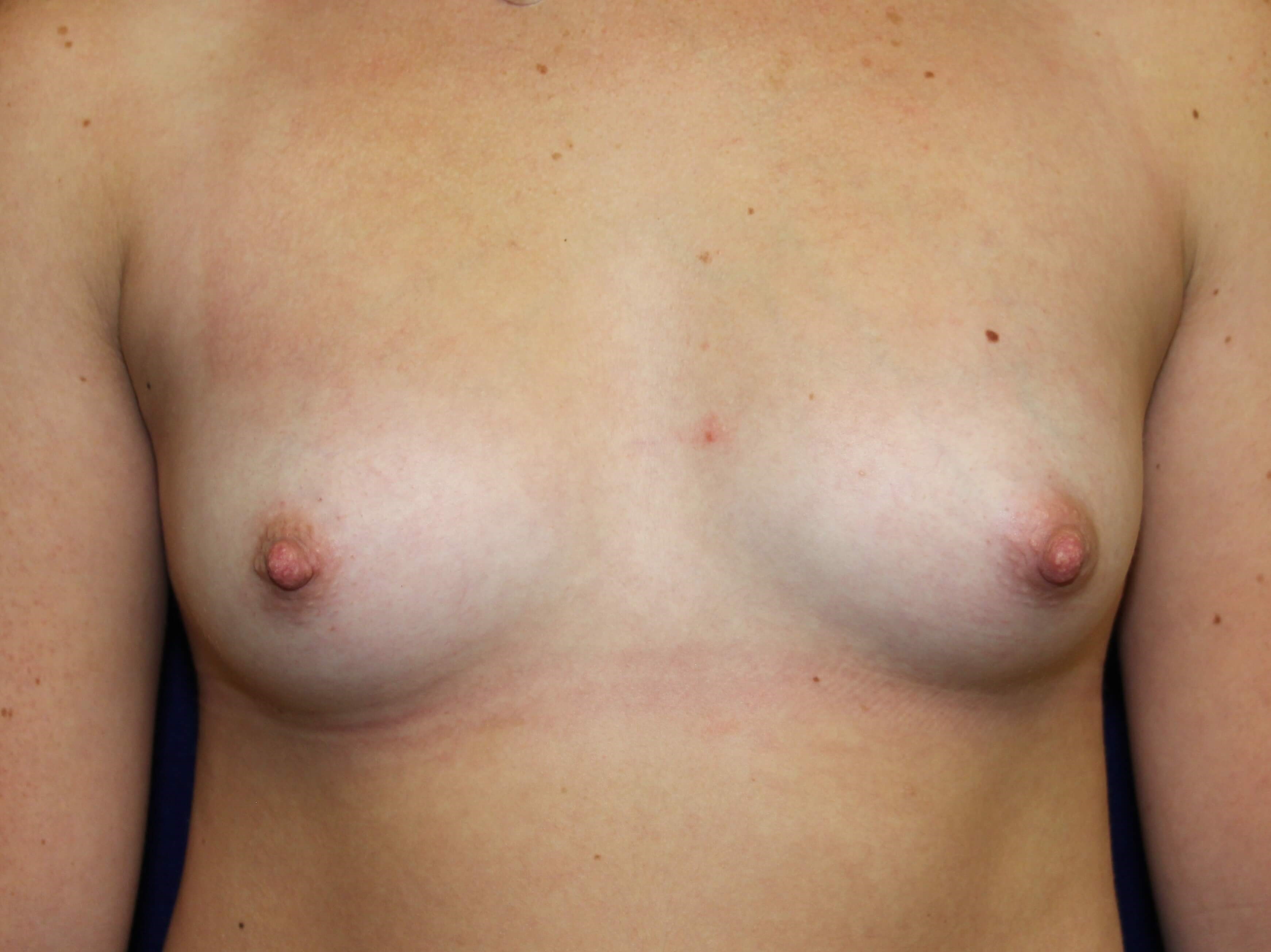 TUBA Implants Before and After Before Breast Implants