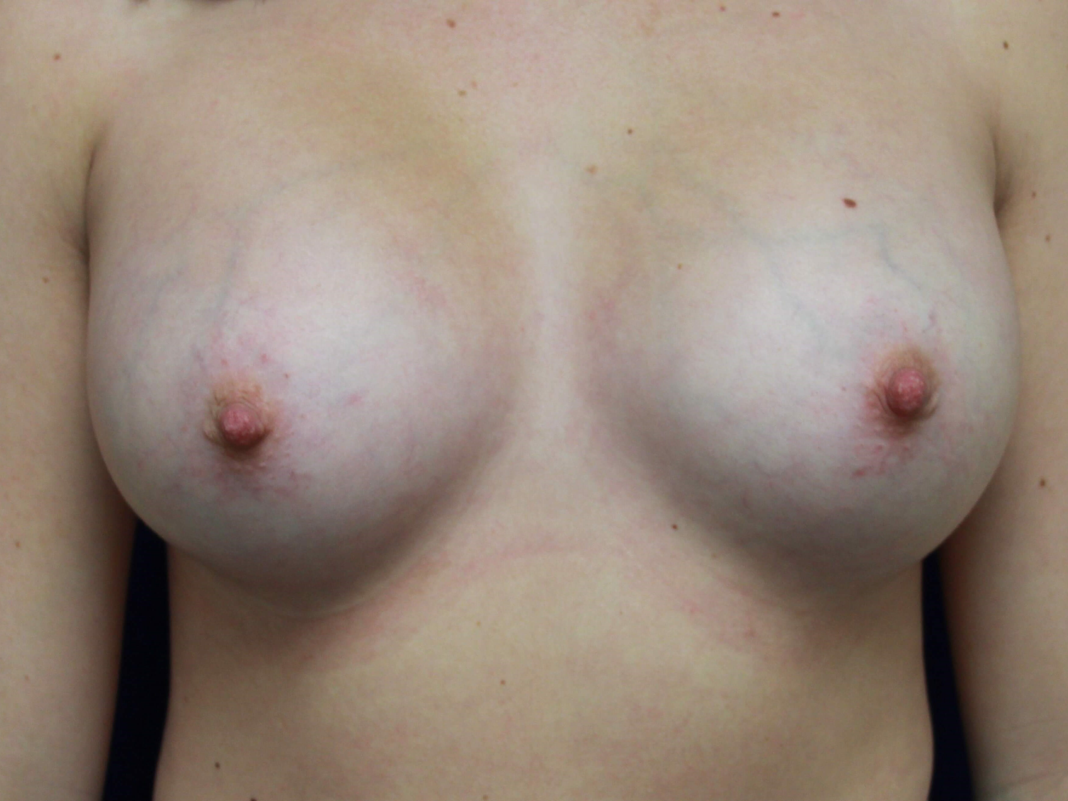 TUBA Implants Before and After After Breast Implants