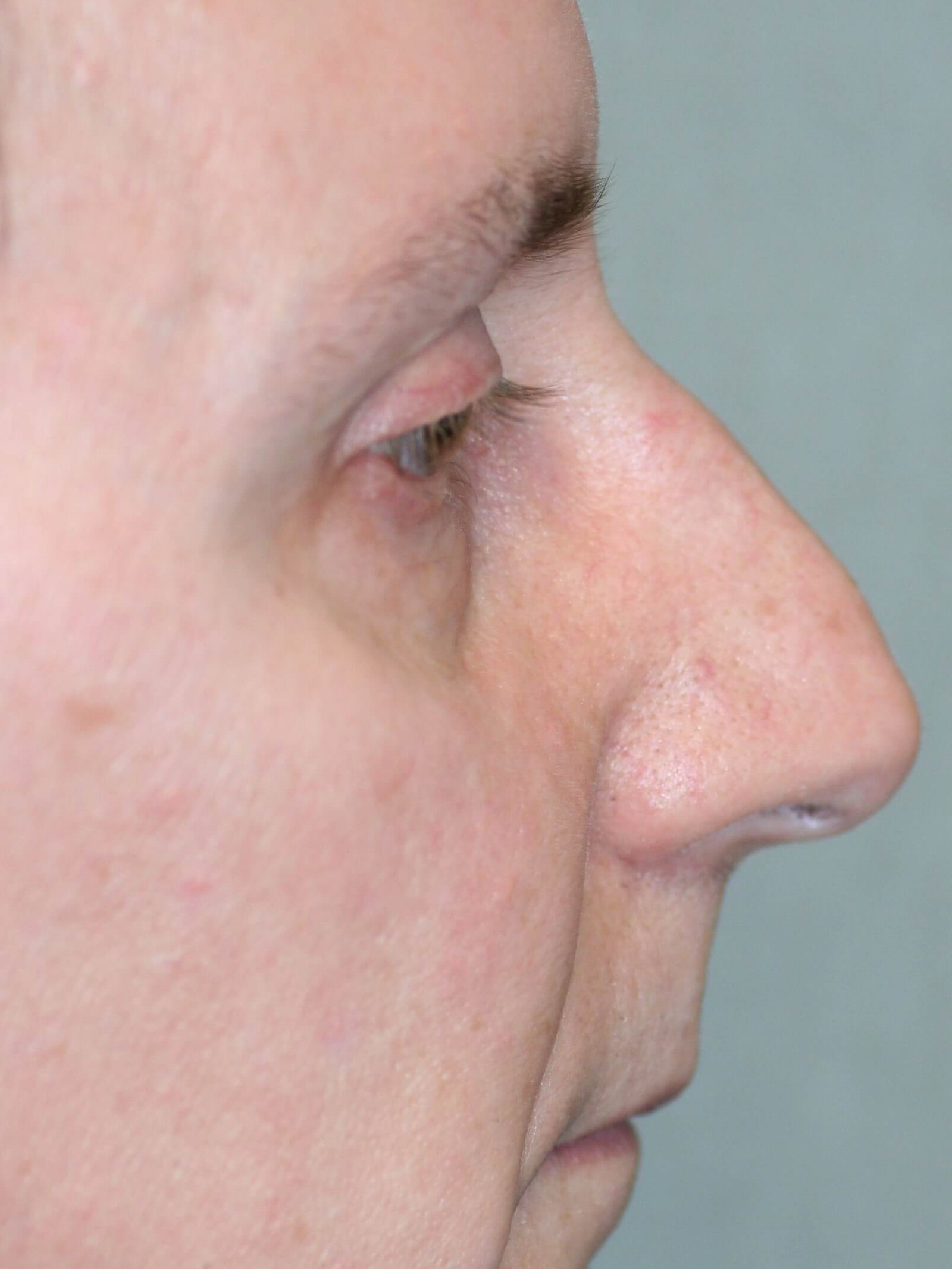 Male Open Rhinoplasty Before