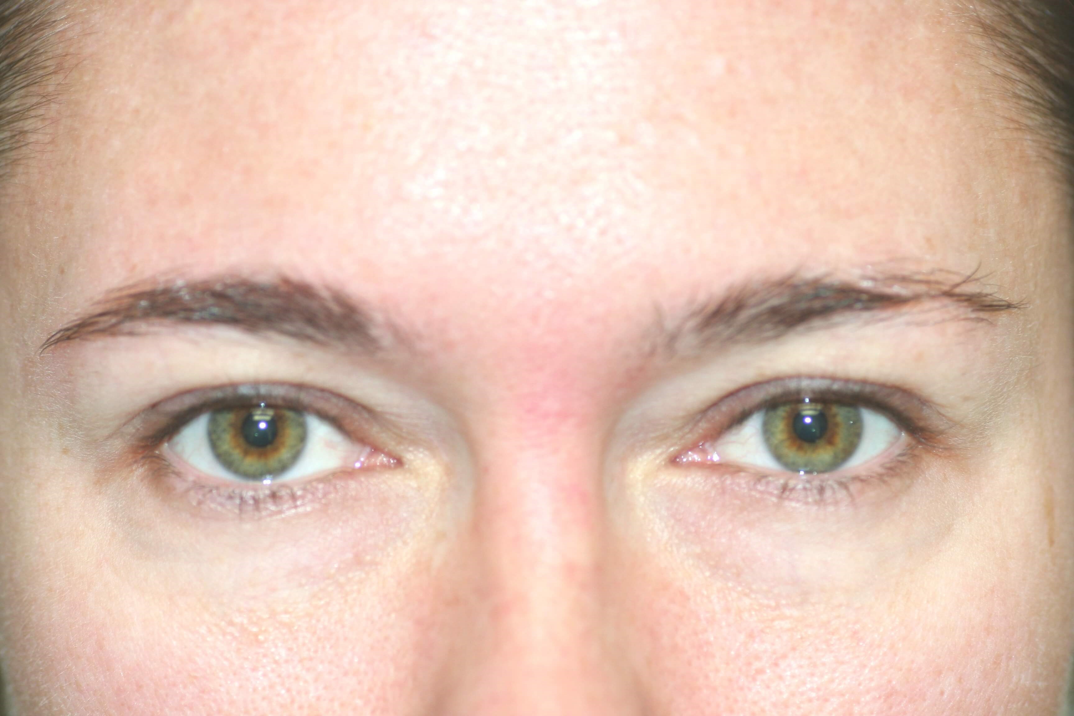 Blepharoplasty Before