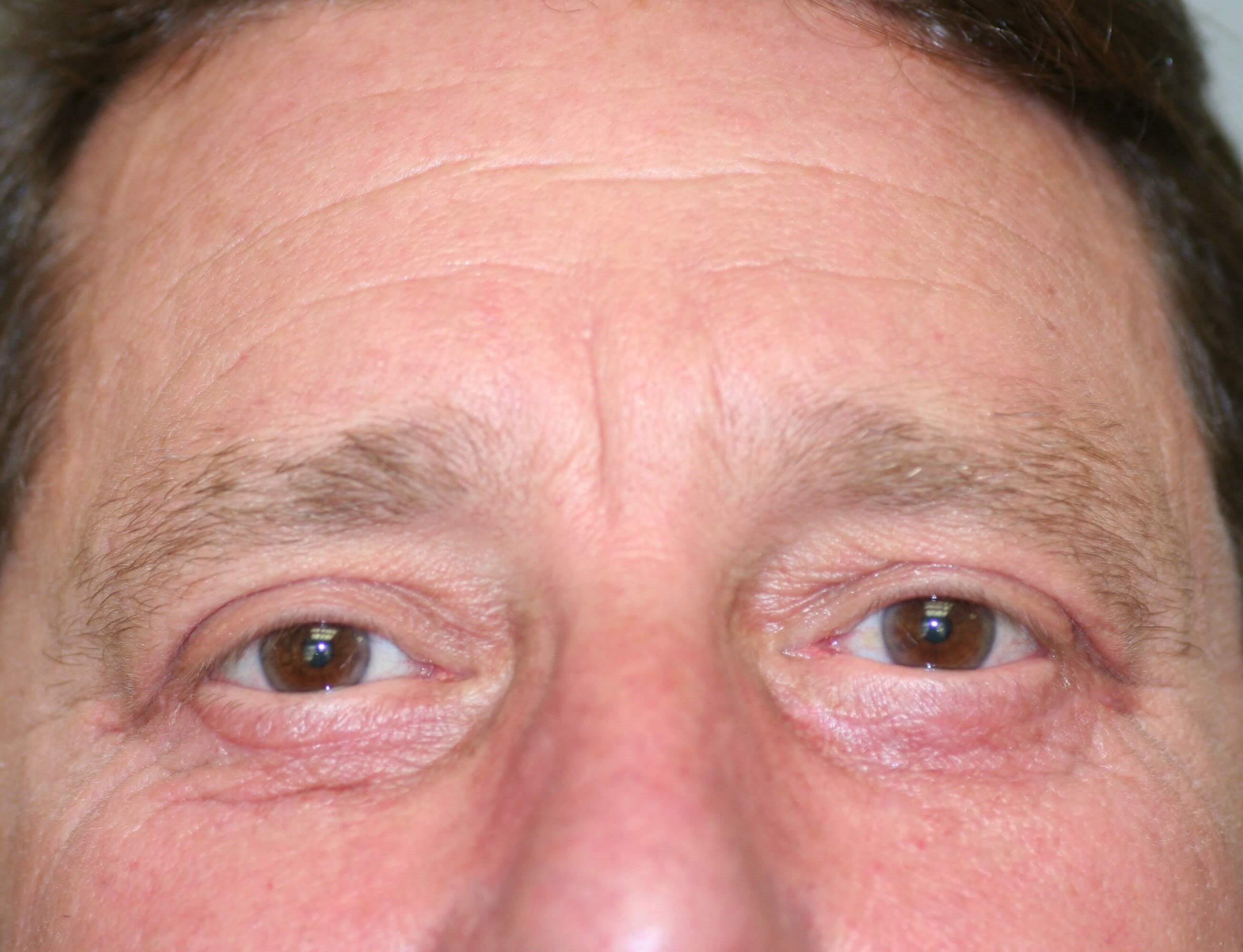 Male Blepharoplasty After