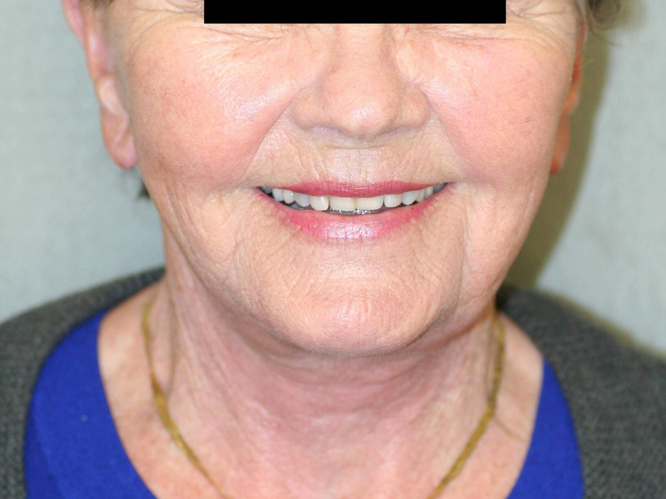 Neck Lift After