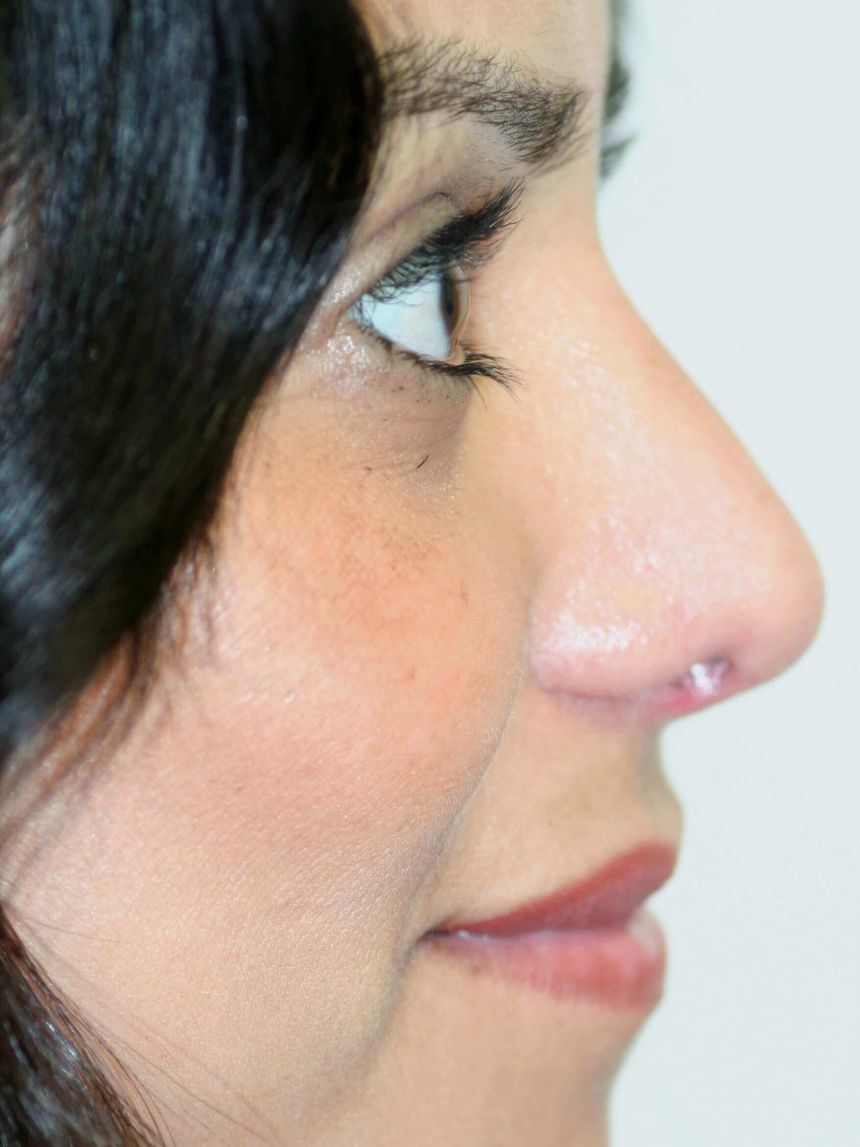 Open Rhinoplasty After
