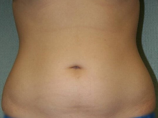 Liposuction Abdomen Before