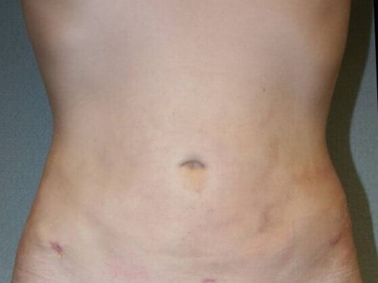 Liposuction Abdomen After