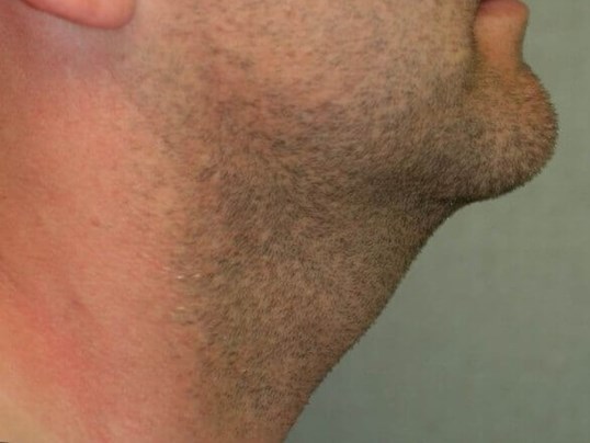 Neck Liposuction Before