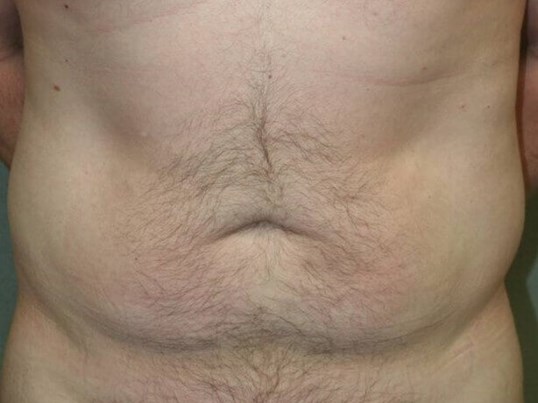 Abdominal Liposuction Before