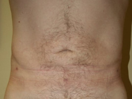 Abdominal Liposuction After