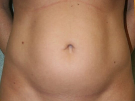 Abdominal Liposuction Before
