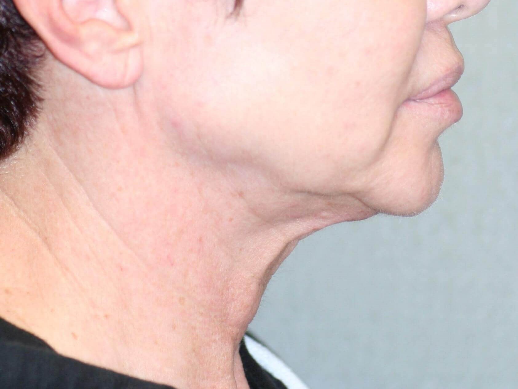 Neck Lift Before