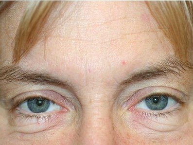 Blepharoplasty Before