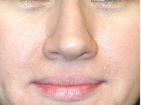Open Rhinoplasty Before