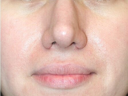 Open Rhinoplasty After