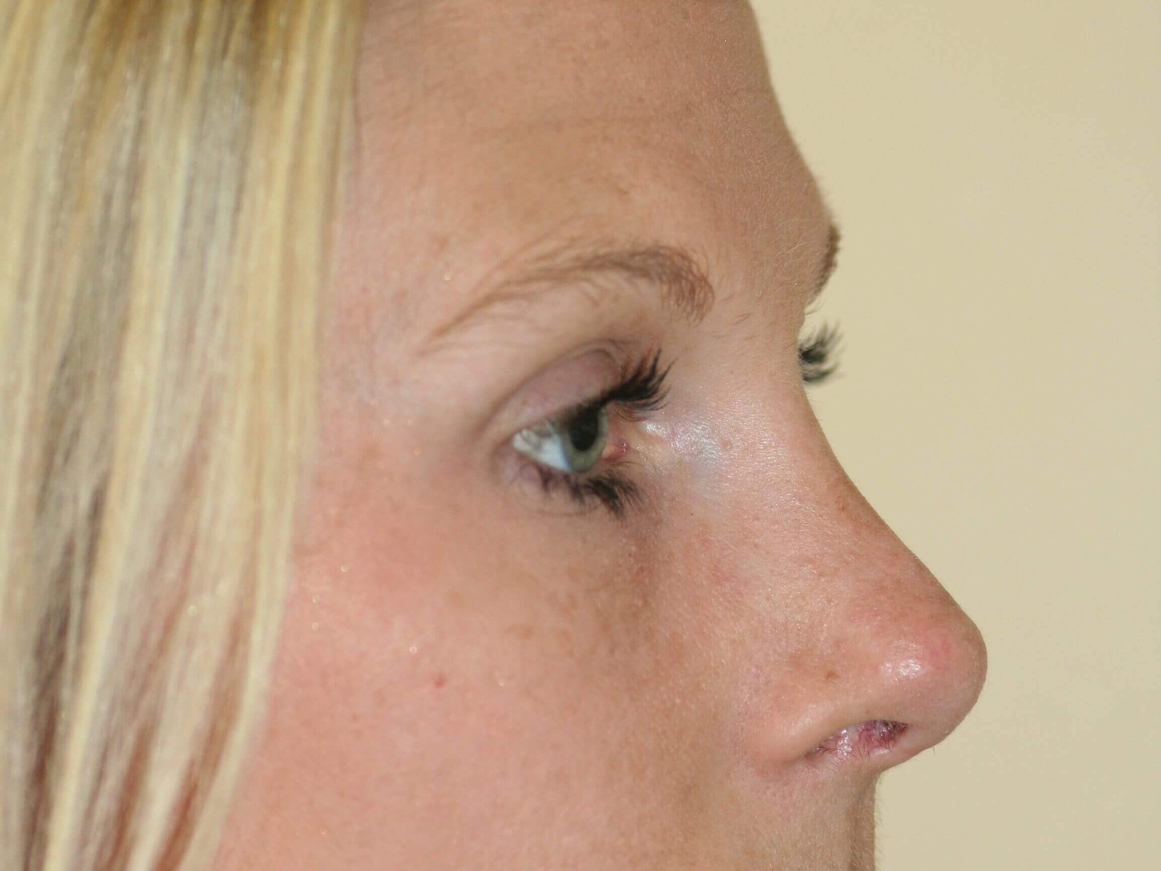 Open Rhinoplasty After