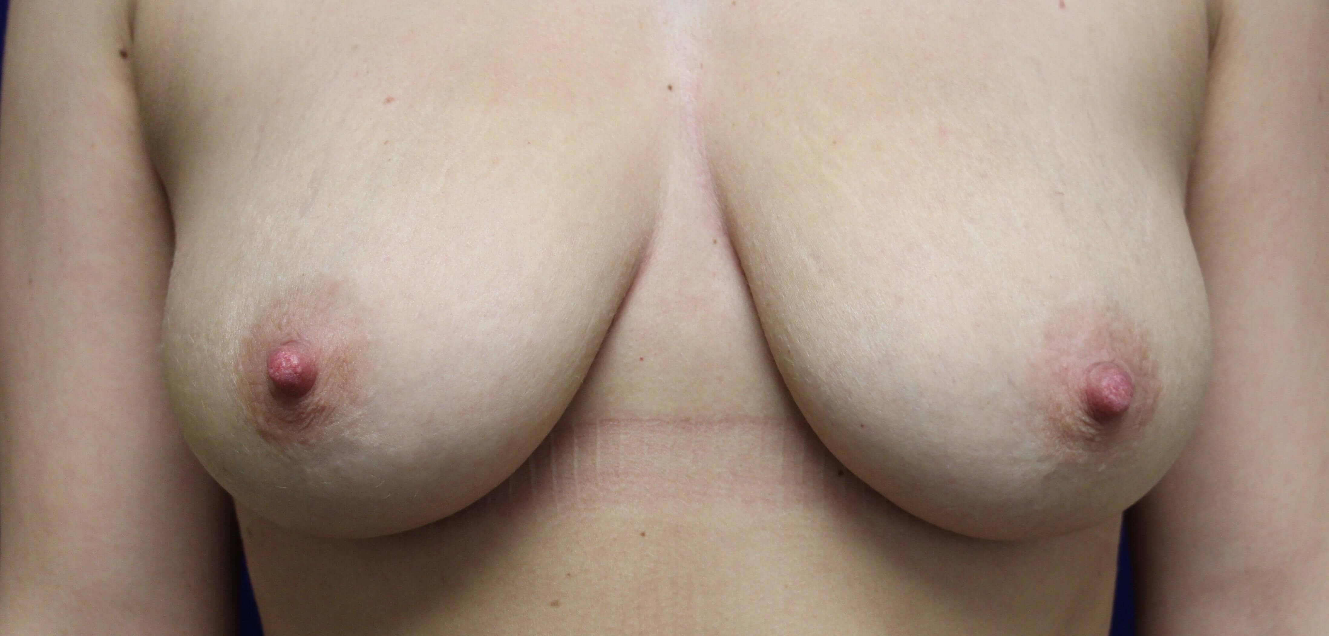 Breast Augmentation Before