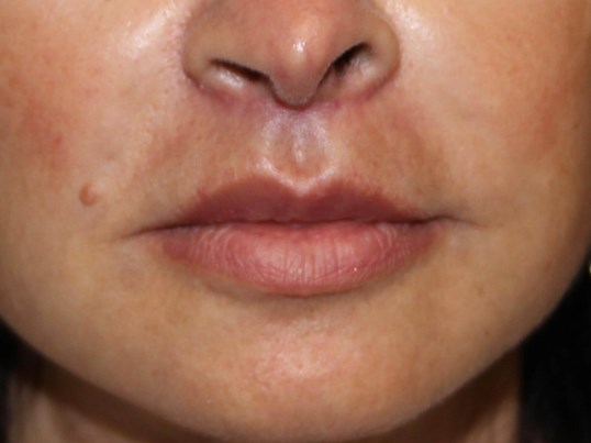 Lip Lift After