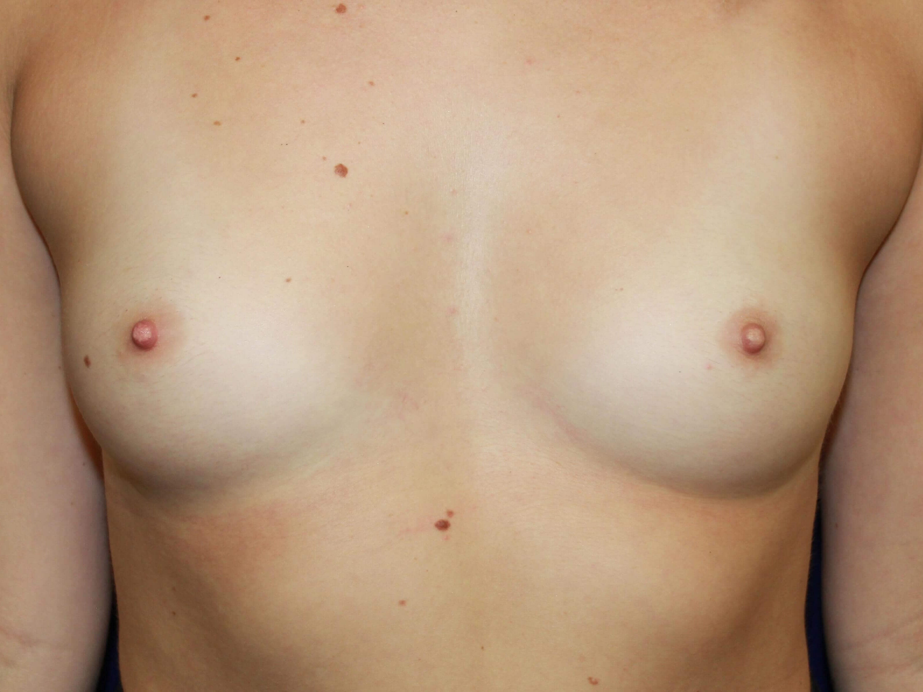 TUBA Breast Augmentation HP Before Breast Implants