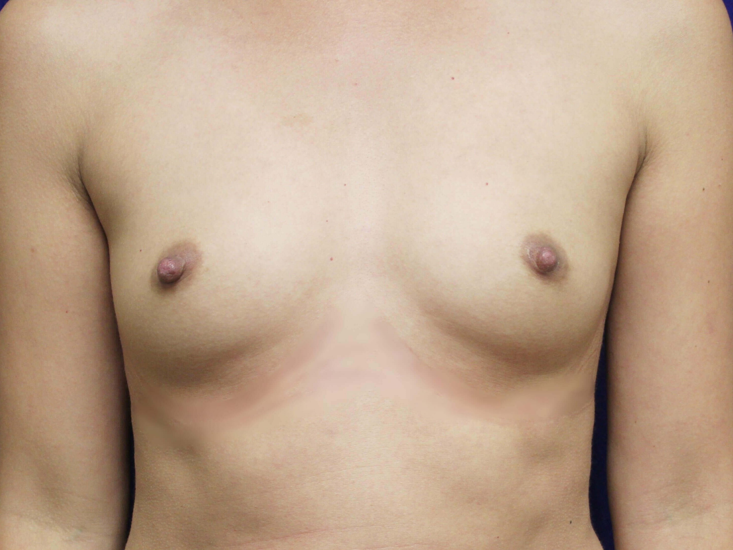TUBA Breast Augmentation Before