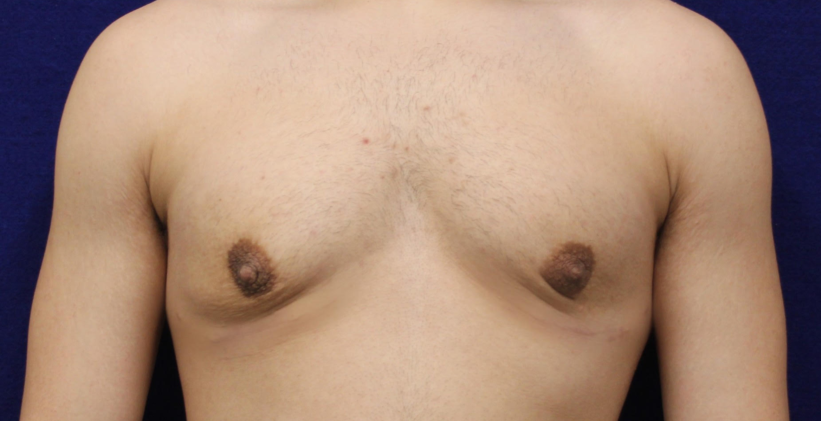 Male Gynecomastia