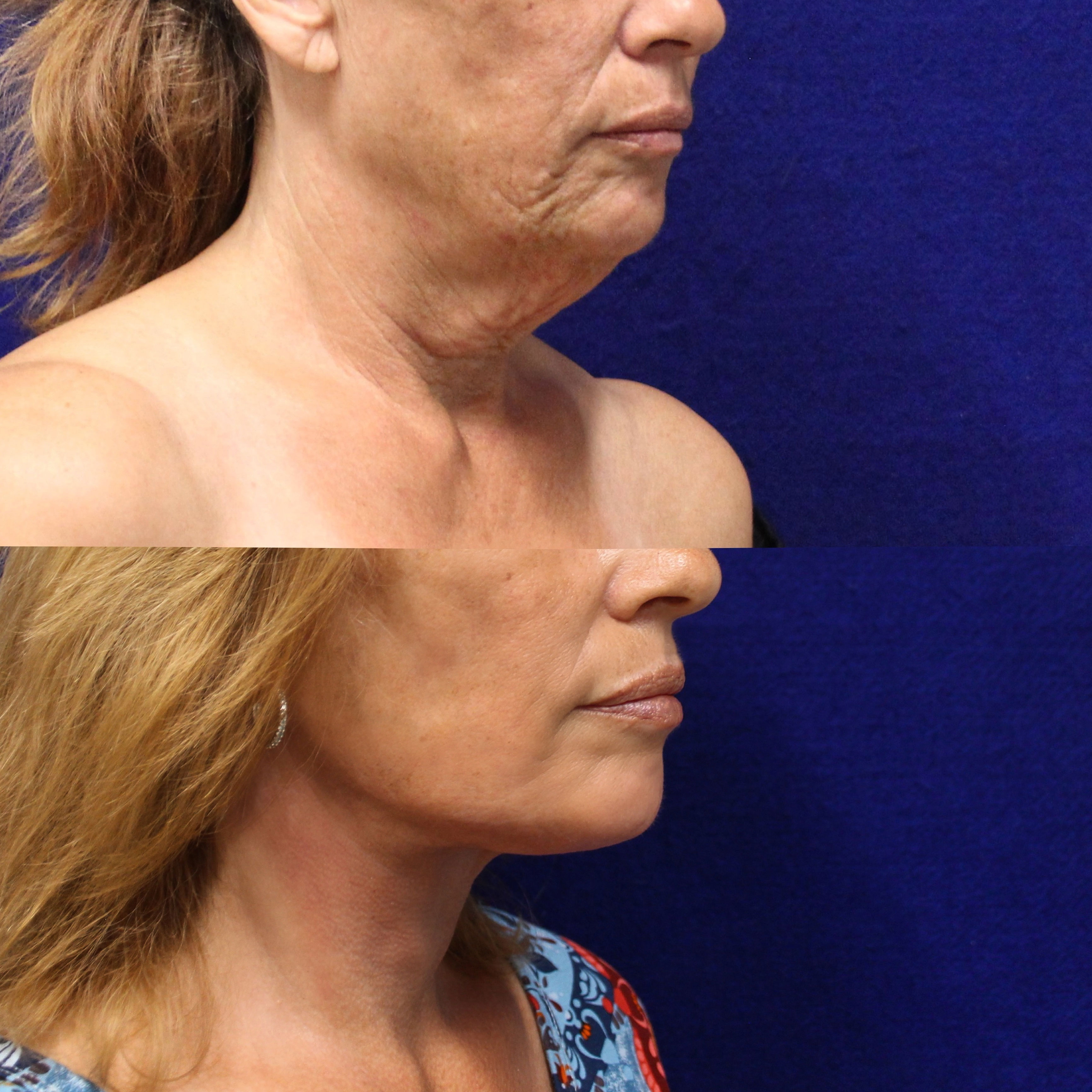 neck lift